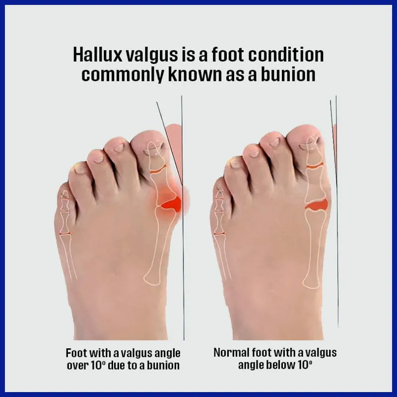 Superior Relief Gel Pad for Sore Bunion | Hallux Valgus Corrector